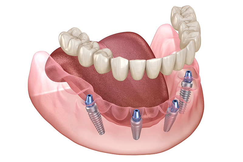All on 4 Dental Implants in Kendall Park & Florham Park