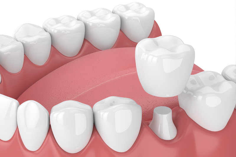 Dental Crowns in Kendall Park & Florham Park