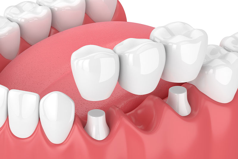 Dental Bridges in Kendall Park & Florham Park