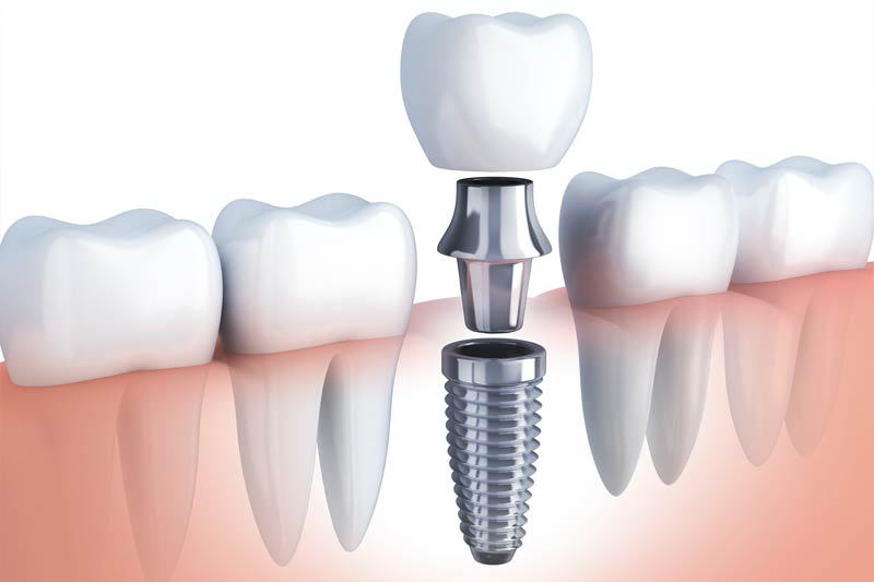 Implants Dentist in Kendall Park & Florham Park