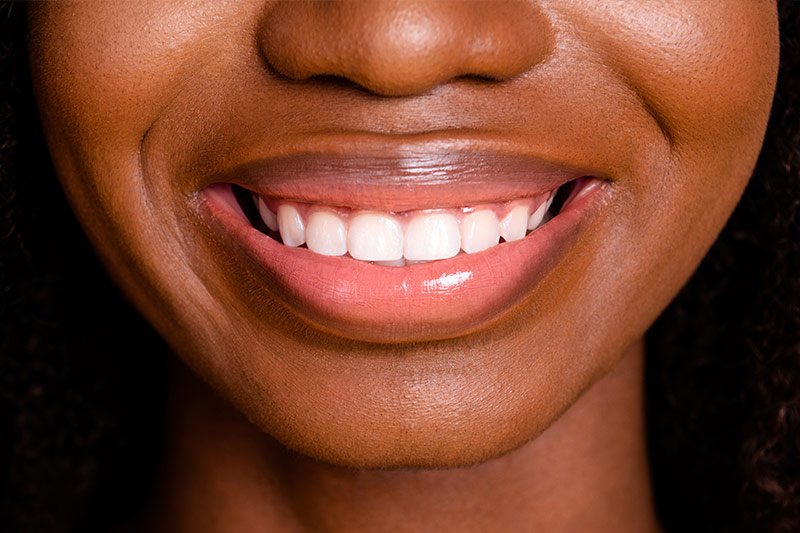 Gummy Smile Treatment in Kendall Park & Florham Park