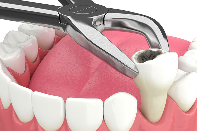 Tooth Extractions in Kendall Park & Florham Park