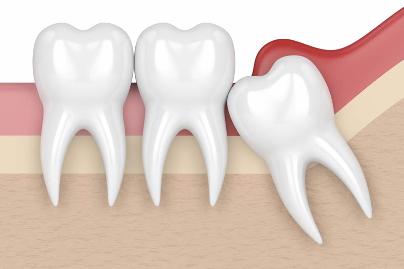 Wisdom Tooth Removal in Kendall Park & Florham Park